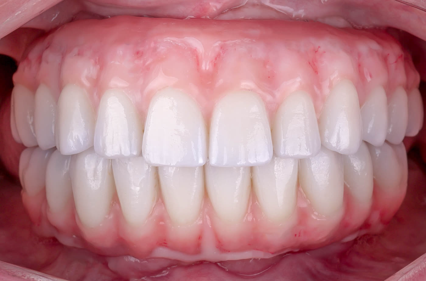 All-on-4 zirconia bridge, final restoration