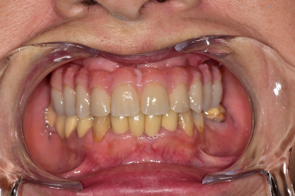 Full-arch restoration try-in, clinical photo