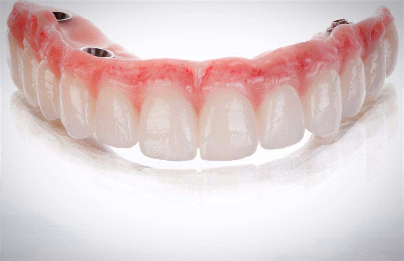 Full-arch screw-retained zirconia restoration