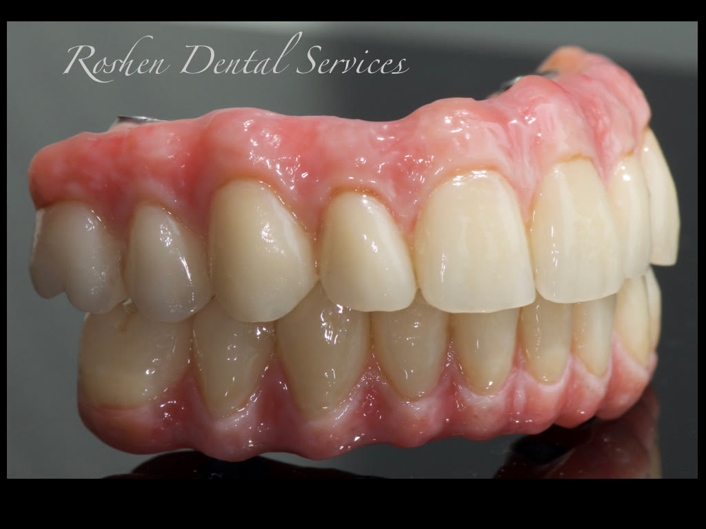 All-On screw-retained zirconia full-arch restoration