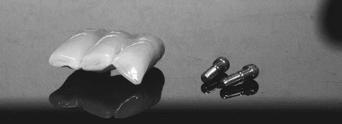 Screw-retained bridge with titanium screws