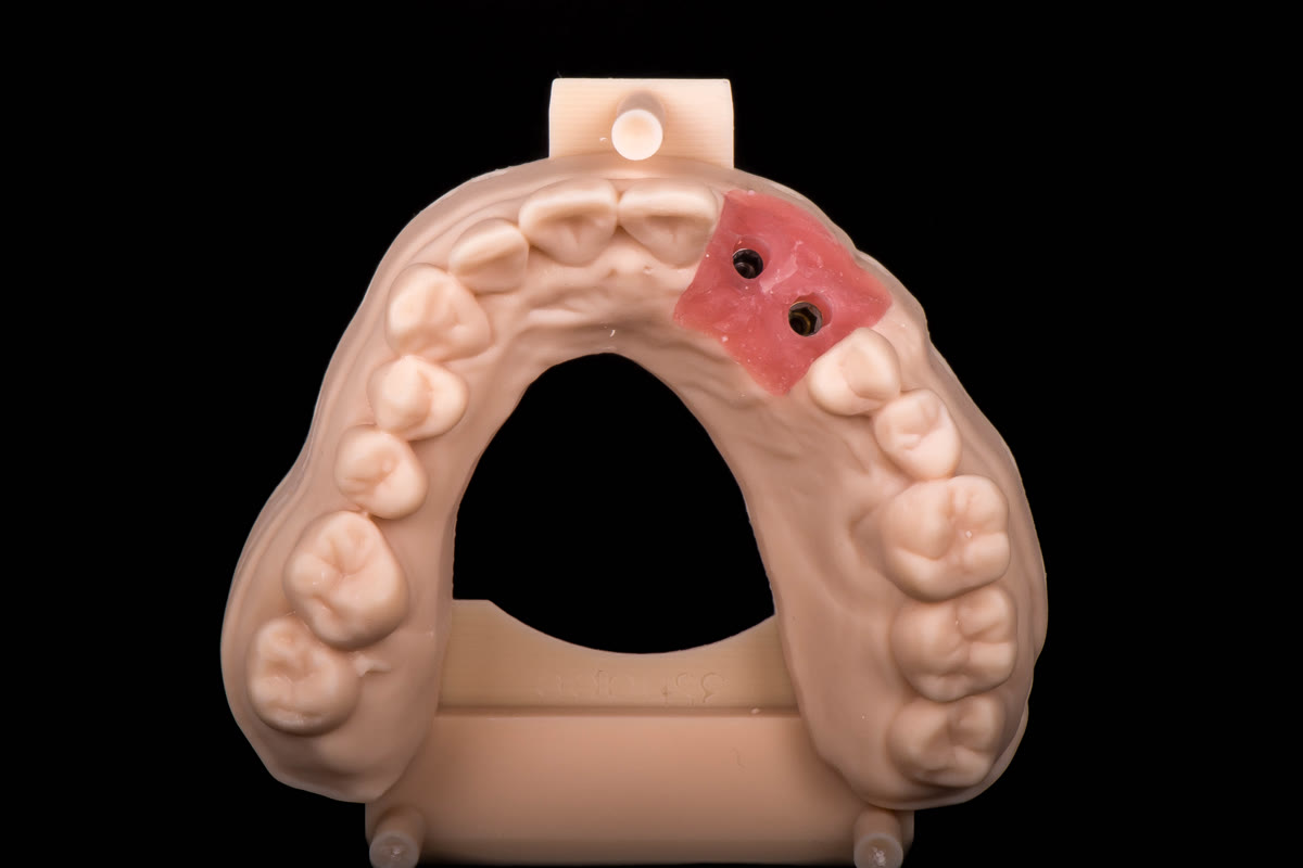 3D-printed implant model with gingival mask